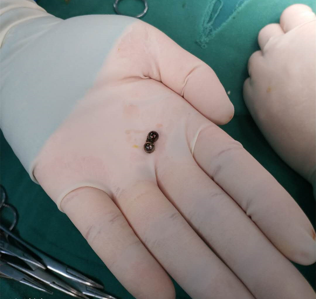 女娃误吞磁力珠致6处肠穿孔,小孩误吞磁力珠