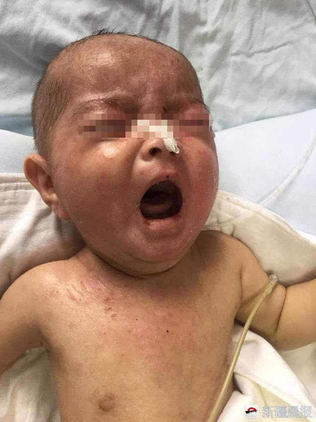 3岁水痘护理,三个月宝宝感染水痘会很严重吗