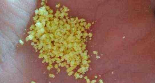 女子结婚恶心呕吐,为什么结婚后都口臭