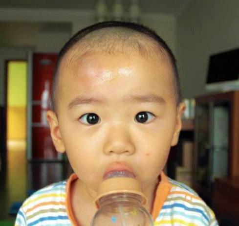 小朋友头被碰了一个包,小孩头上被车撞一个大包怎么办