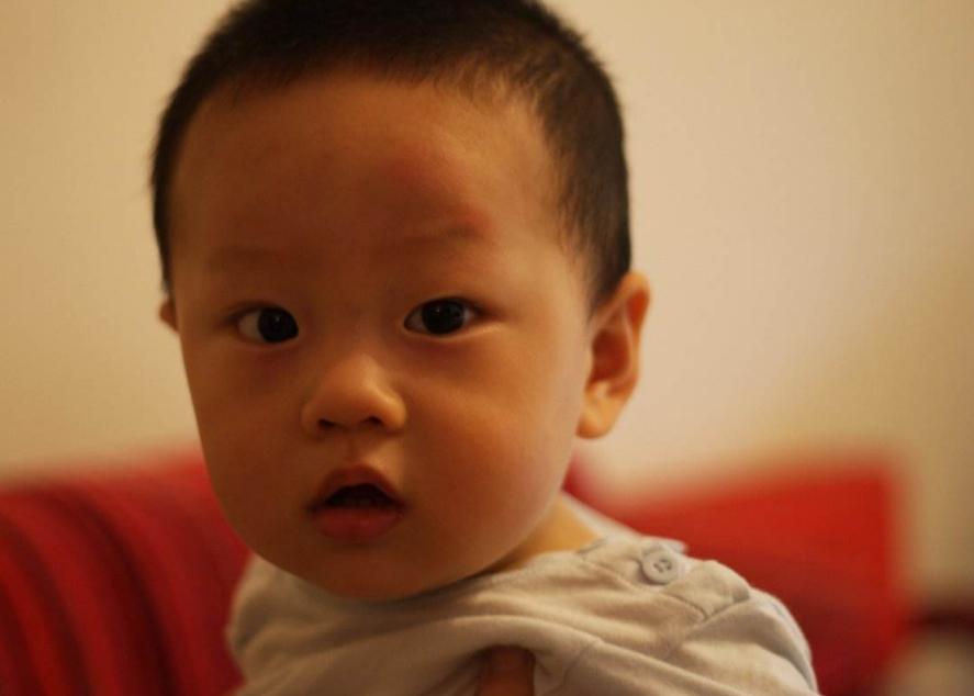 小朋友头被碰了一个包,小孩头上被车撞一个大包怎么办