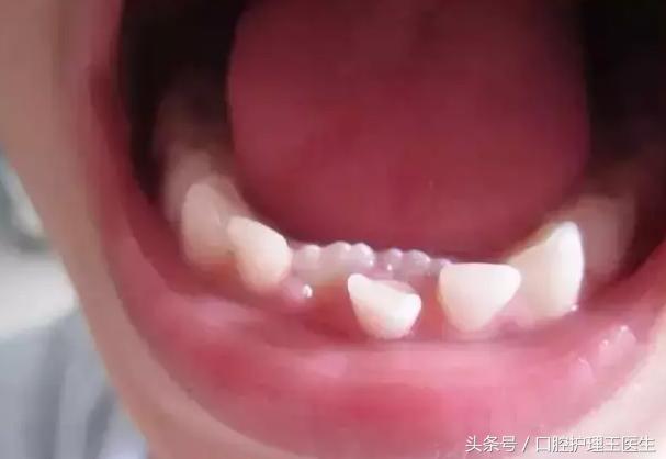 小孩双层牙怎么回事,儿童双层牙齿是怎么回事