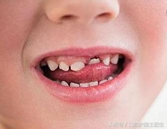 小孩双层牙怎么回事,儿童双层牙齿是怎么回事