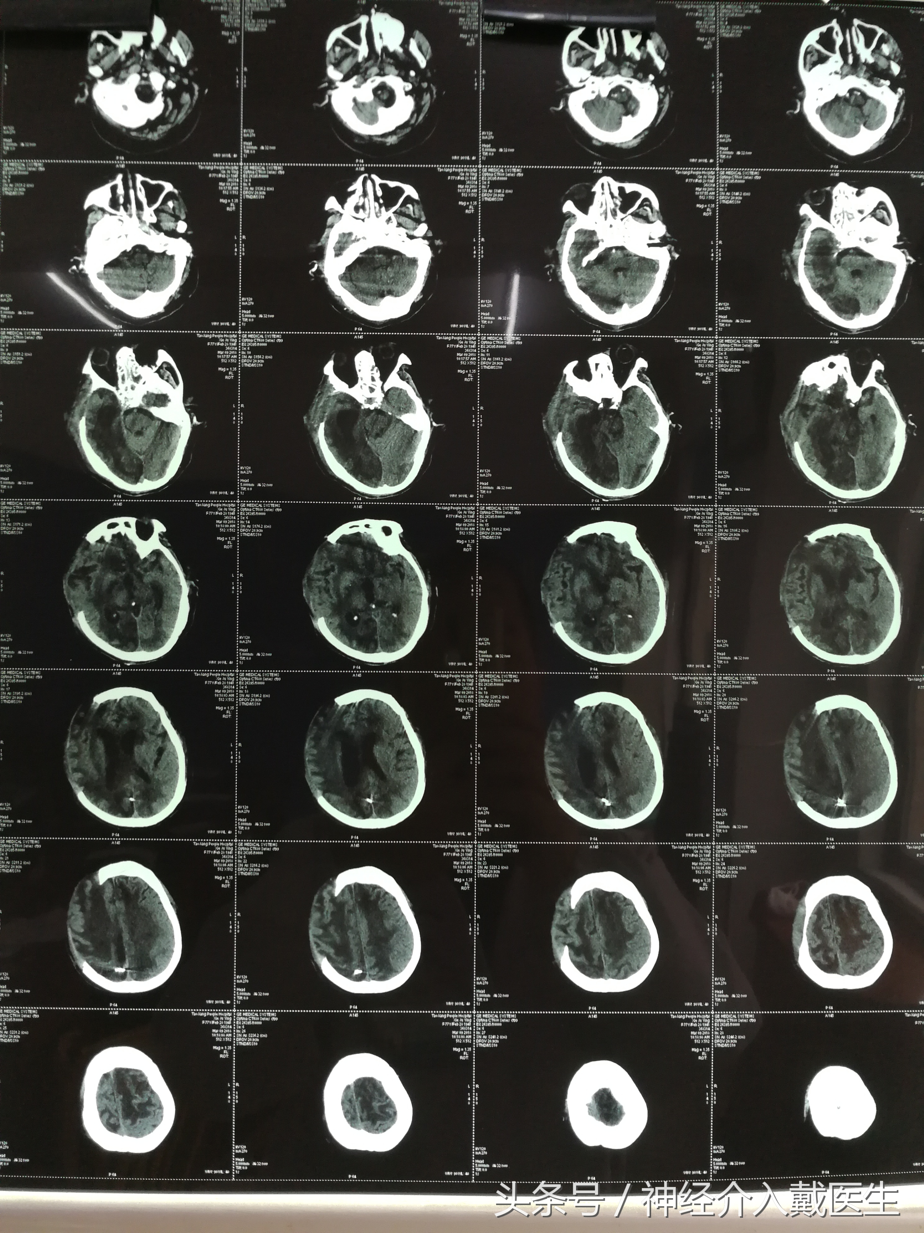 脑出血100ml有奇迹吗,脑出血后遗症奇迹痊愈