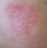 婴幼儿湿疹吃什么药,婴幼儿干性湿疹怎么用药