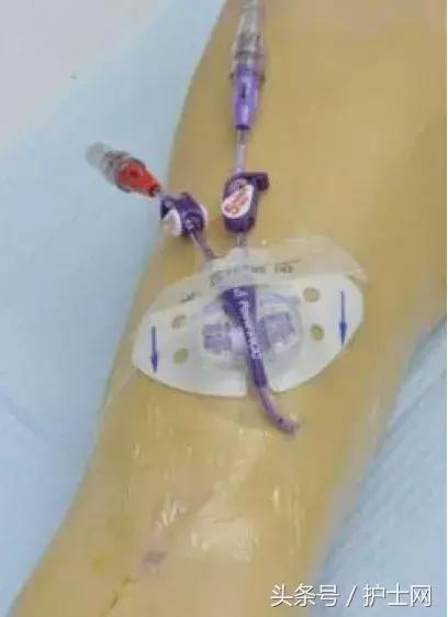 picc置管术在颈部吗,颈部picc管是怎么放进去的