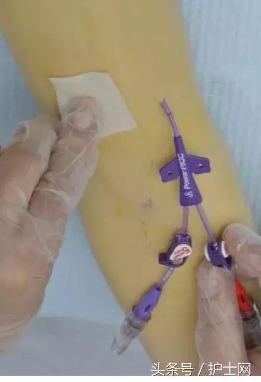 picc置管术在颈部吗,颈部picc管是怎么放进去的