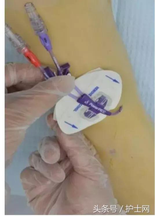 picc置管术在颈部吗,颈部picc管是怎么放进去的