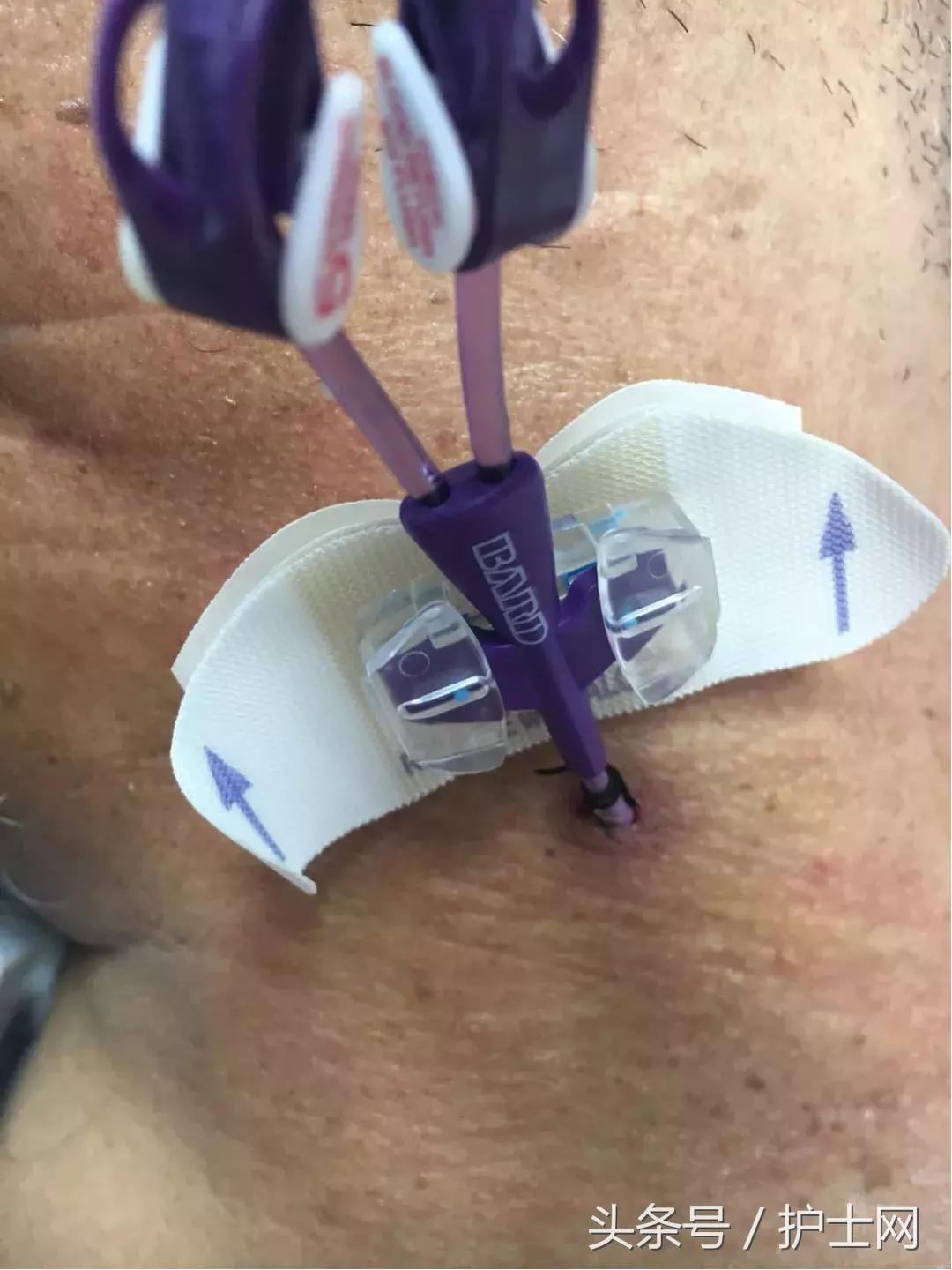 picc置管术在颈部吗,颈部picc管是怎么放进去的