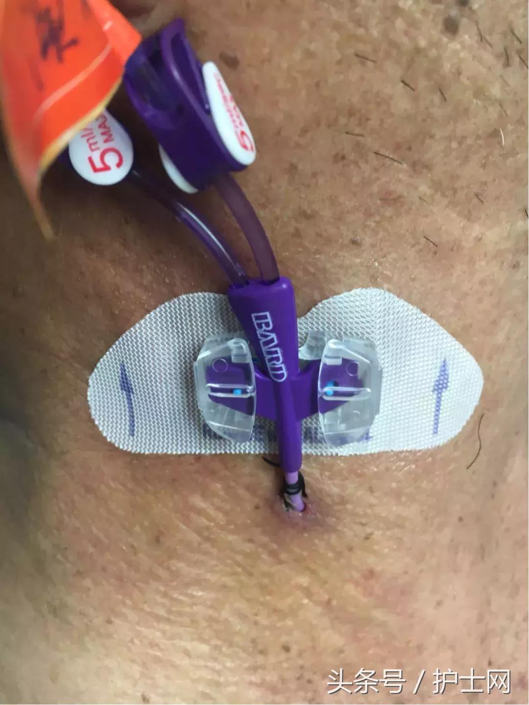 picc置管术在颈部吗,颈部picc管是怎么放进去的