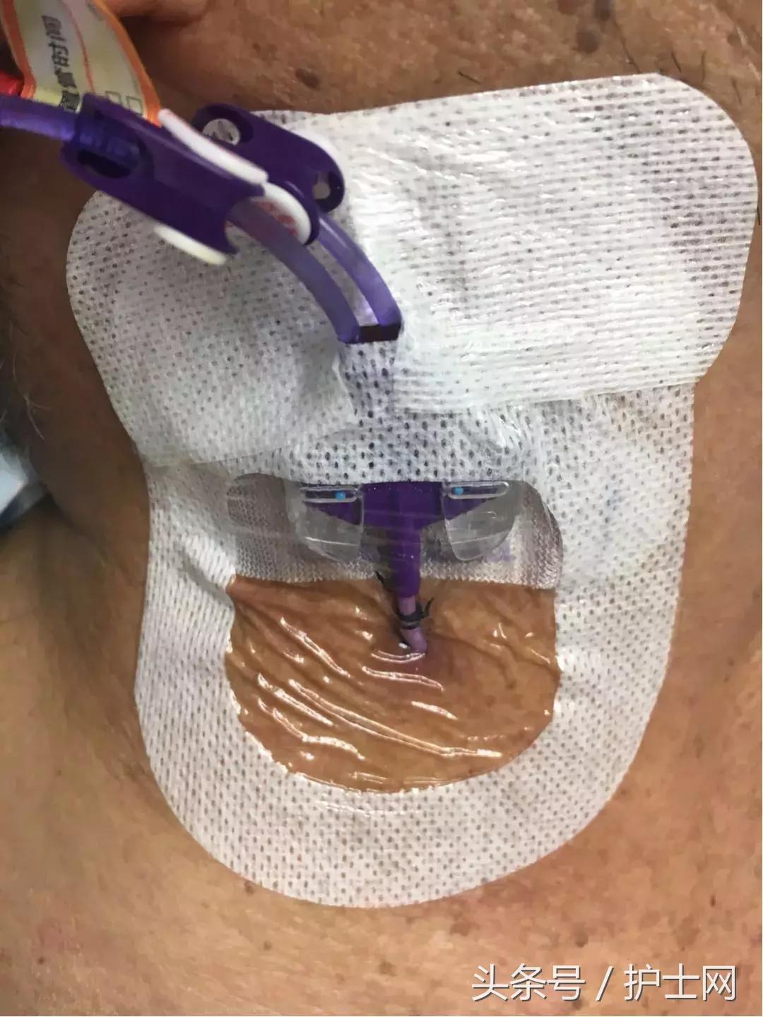 picc置管术在颈部吗,颈部picc管是怎么放进去的