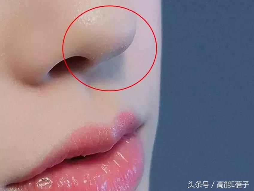 蔡徐坤、Angelababy都根治不掉的黑头，微商神器能去除？