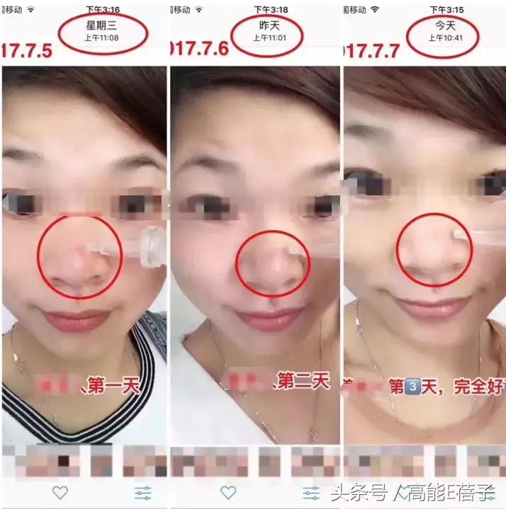 蔡徐坤、Angelababy都根治不掉的黑头，微商神器能去除？