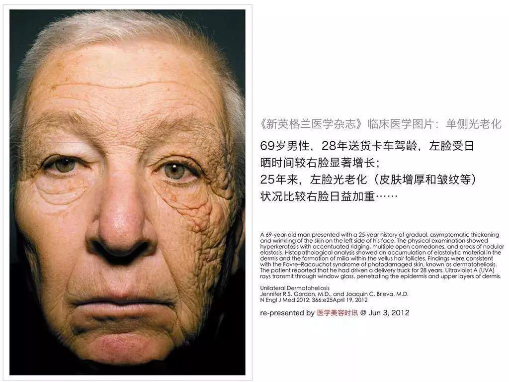 艾玛沃森的颜值变化,艾玛沃森素颜雀斑脸