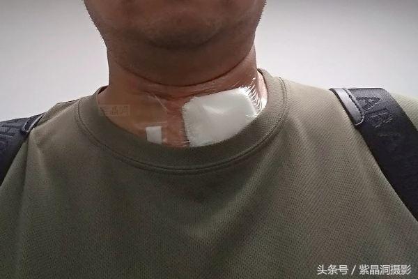 甲状腺结节手术需要住院几天出院,甲状腺结节做消融手术多少天出院