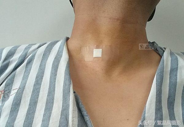 甲状腺结节手术需要住院几天出院,甲状腺结节做消融手术多少天出院