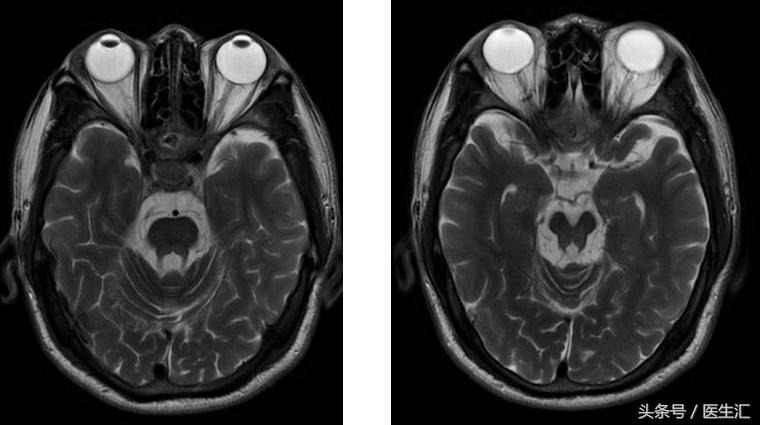 肝豆状核变性食谱,肝豆状核变性基因检测