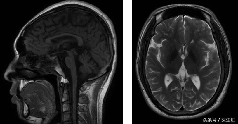 肝豆状核变性食谱,肝豆状核变性基因检测