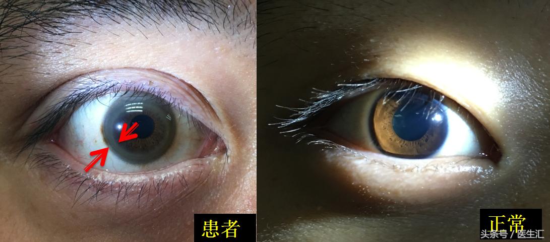 肝豆状核变性食谱,肝豆状核变性基因检测