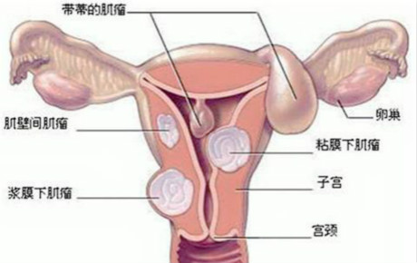 哪些征兆应该警惕子宫肌瘤疾病呢,子宫肌瘤3个诱因看你中了哪个