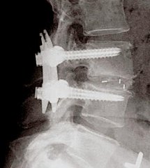 椎间盘突出症术后还会复发吗？