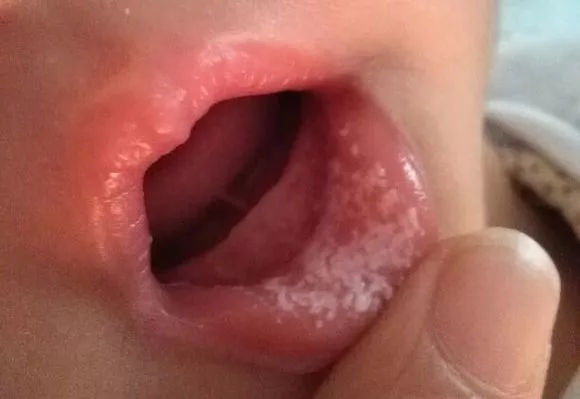 6个月宝宝口腔疾病有哪些,宝宝嘴疼可能与哪些口腔疾病有关