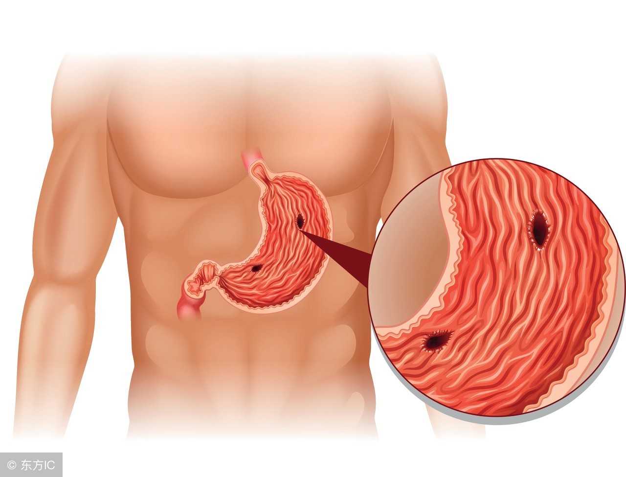 胃溃疡有哪些并发症,胃溃疡患者出现哪些症状提示癌变