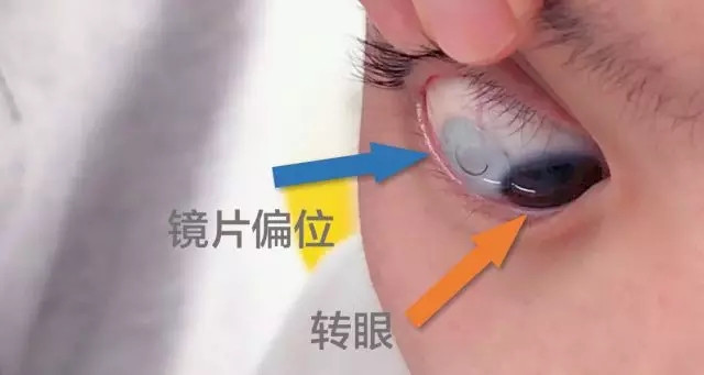 ok镜怎样戴减少气泡,ok镜带偏处理方法