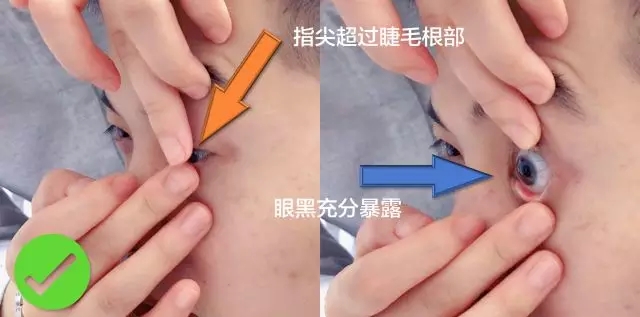 ok镜怎样戴减少气泡,ok镜带偏处理方法