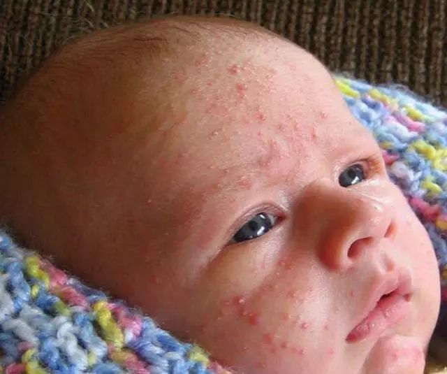 脂溢性皮炎和皮脂腺异位有关系吗,宝宝湿疹痤疮的区别