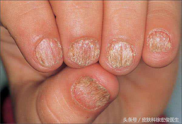 灰指甲指甲变小变厚变畸形怎么办,指甲变厚一定是灰指甲吗