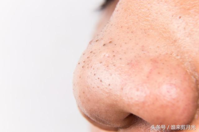 去草莓鼻小妙招简单有效的,告别草莓鼻肌肤干干净净