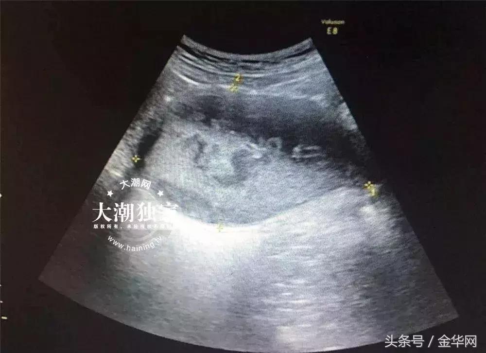 卫生间一洗澡就有一股臭味啥原因,12岁女孩身上恶臭难闻