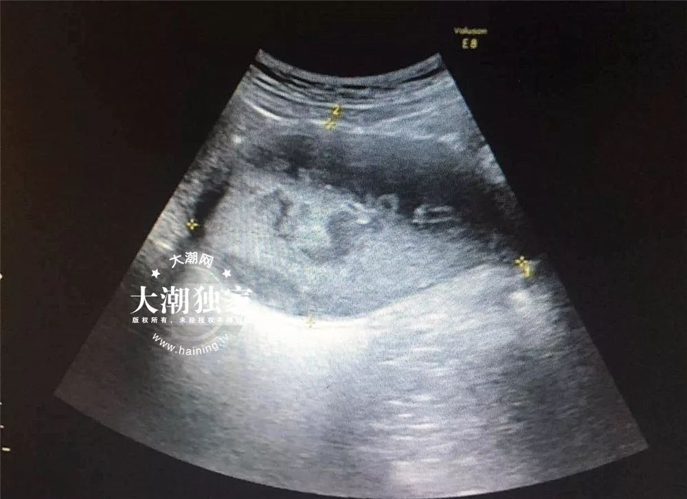 12岁女孩身上恶臭难闻,15岁女孩身上突然有难闻的味道