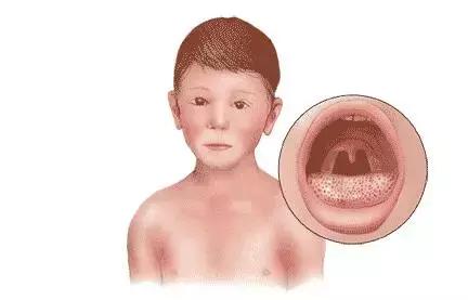 孩子发烧急疹,孩子发烧后出疹子是什么原因呢