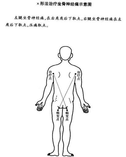 纯阳灸疗法治疗坐骨神经痛,老人坐骨神经痛推拿