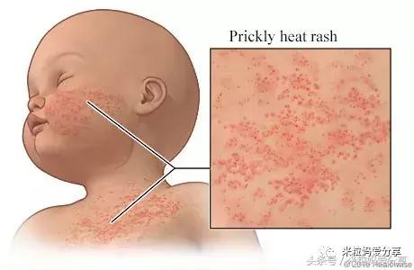 宝宝起疹的最佳治疗方法,孩子发烧后出疹怎么护理
