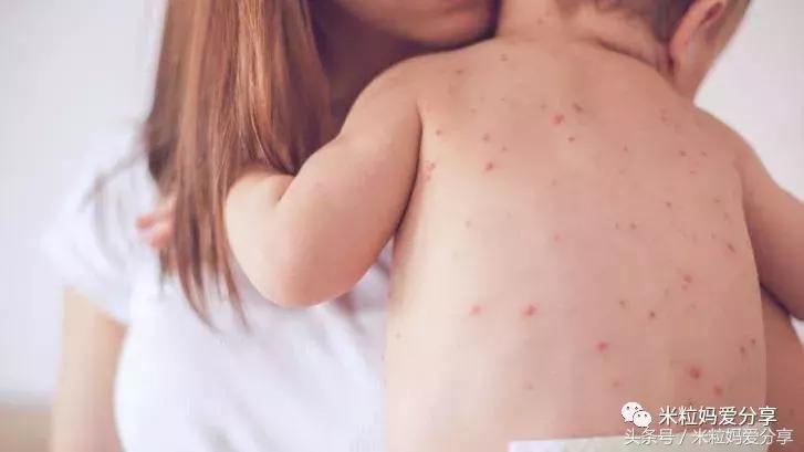 宝宝起疹的最佳治疗方法,孩子发烧后出疹怎么护理