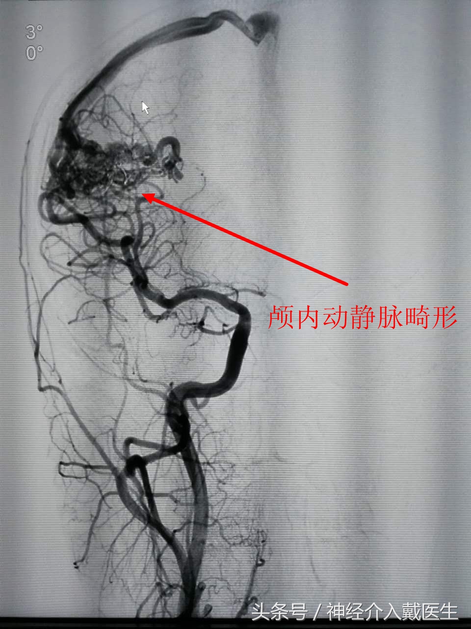 年轻人如何预防和缓解脑血管疾病,如何确诊脑血管疾病