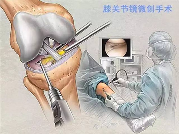 风湿性膝关节炎症状和治疗方法,退行性膝关节炎怎样治疗好得快