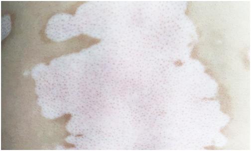 「白癜风援助纪实」8岁男孩与白魔顽强抗争在国丹终收获了希望