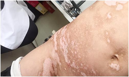 「白癜风援助纪实」8岁男孩与白魔顽强抗争在国丹终收获了希望