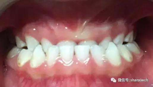 育儿知识关于牙齿,育儿知识幼儿牙齿敏感期