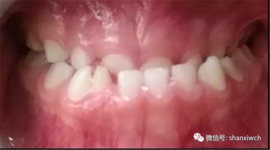 育儿知识关于牙齿,育儿知识幼儿牙齿敏感期