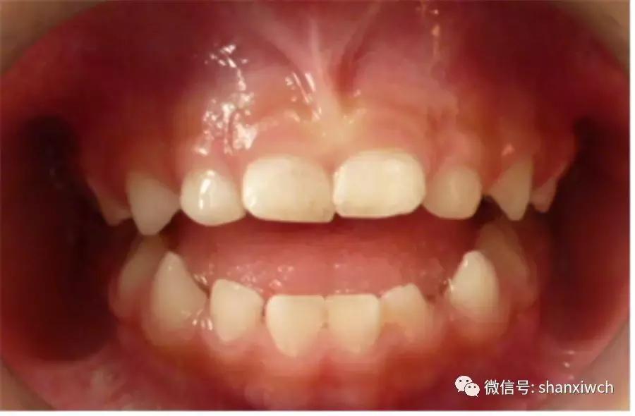 育儿知识关于牙齿,育儿知识幼儿牙齿敏感期