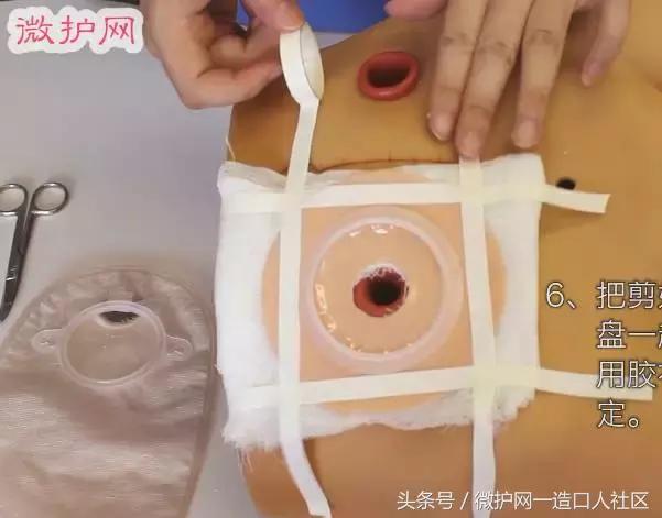造口护理小窍门视频,更换造口护理技术操作流程