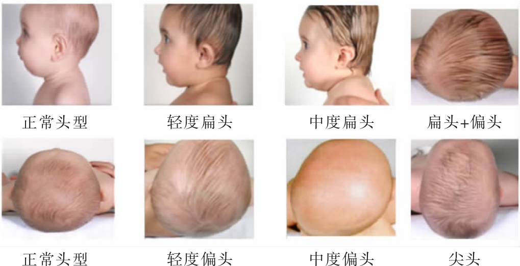 圆头扁头对颜值的影响,扁头对颜值的伤害