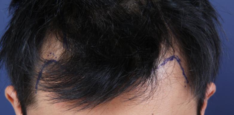 看看你属于哪种额头,有什么样的额头