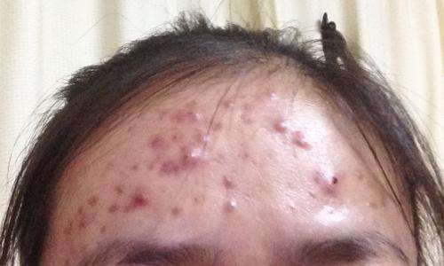 去黑头草莓鼻最有效的方法,怎么去黑头不会变草莓鼻