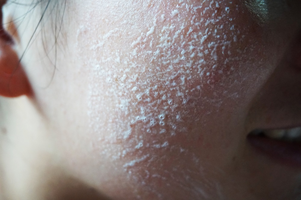 去黑头草莓鼻最有效的方法,怎么去黑头不会变草莓鼻